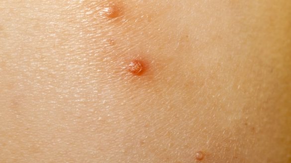 Molluscum Contagiosum