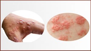 Le Zona - Au coeur de ma santé