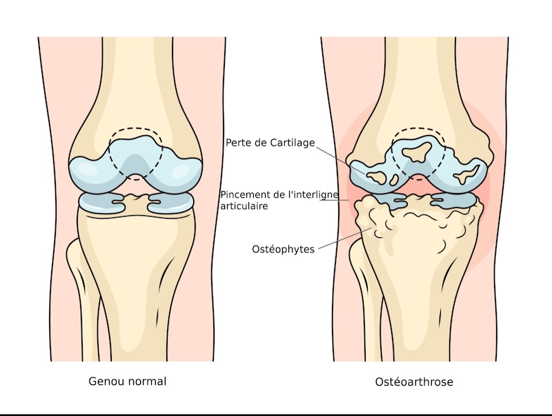 Ostéoarthrose