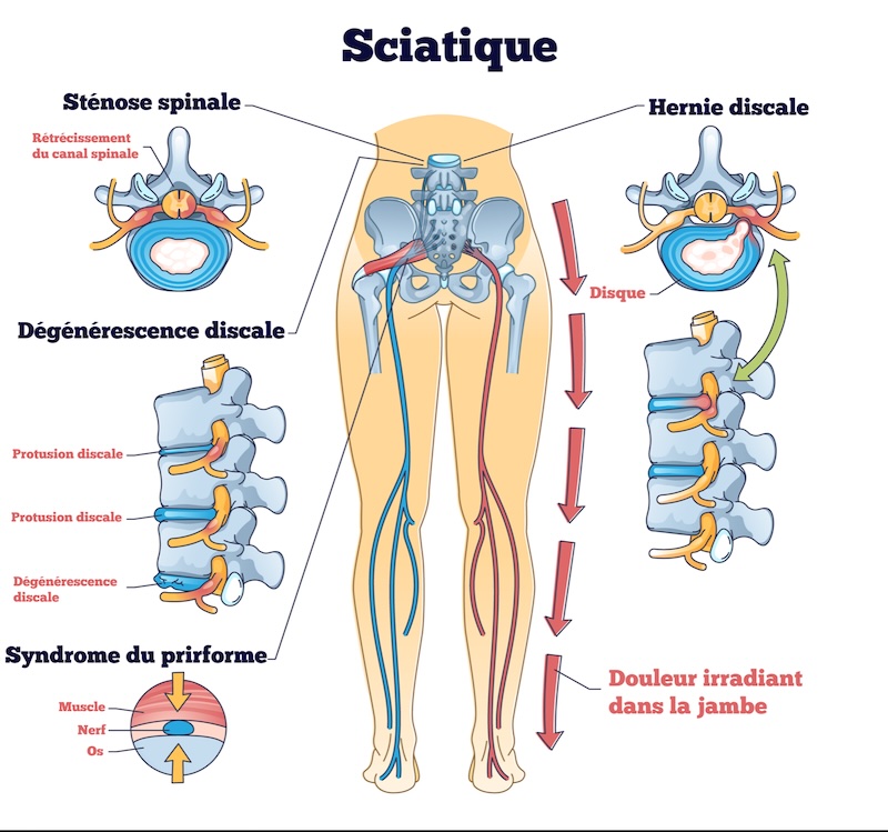 Sciatique