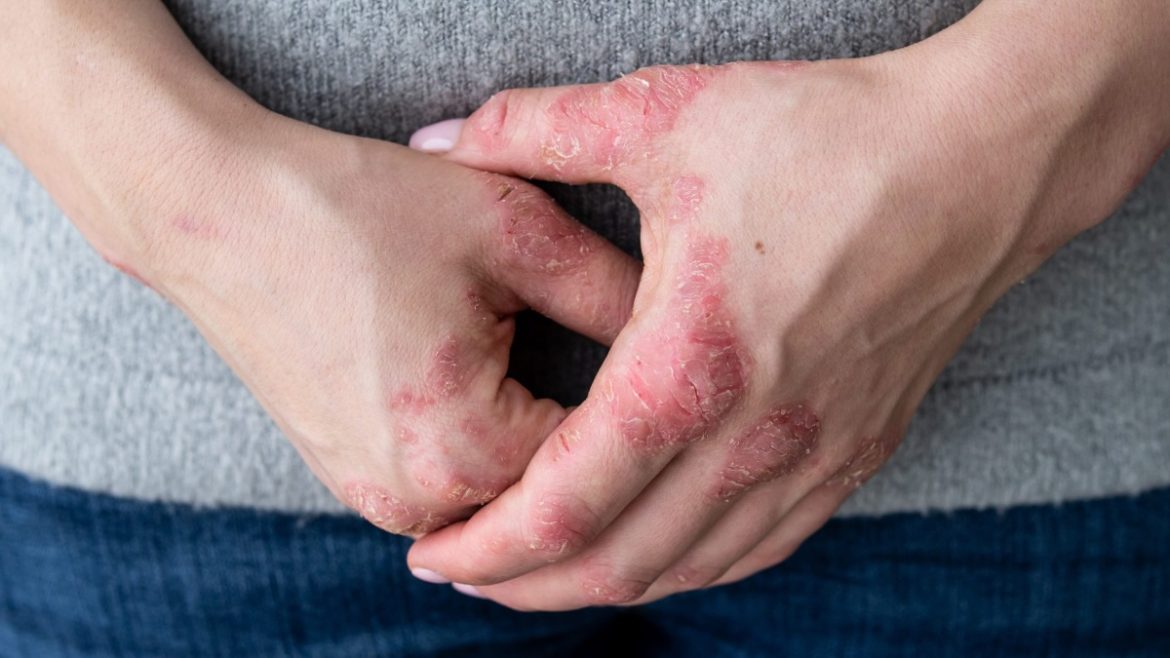 Eczéma
