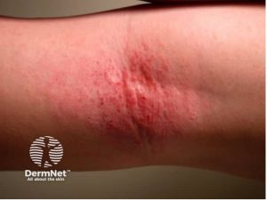 Eczema
