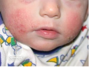 Eczema visage enfant