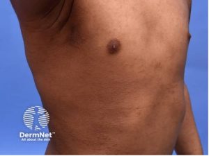 Eczema ventre