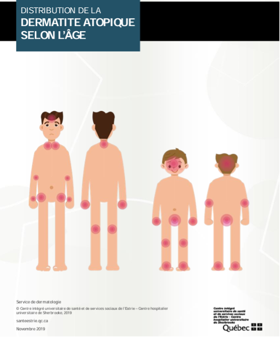 Eczema endroits